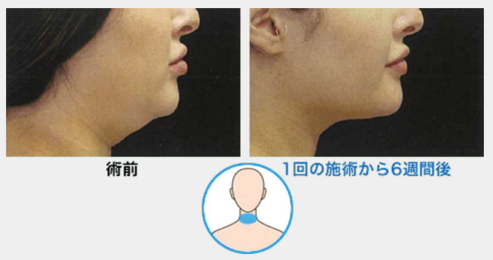SBC　クルスカ　症例