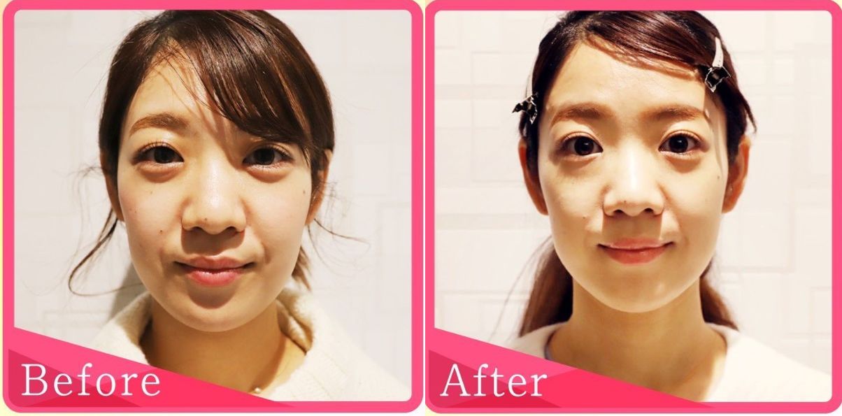 ファイヤークリニックのBNLS症例写真