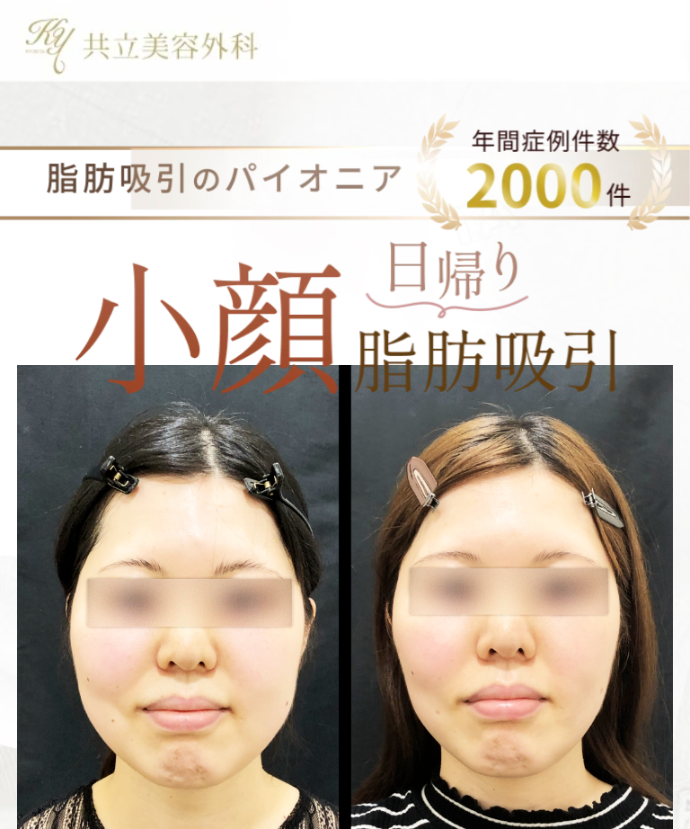 共立美容外科の脂肪吸引