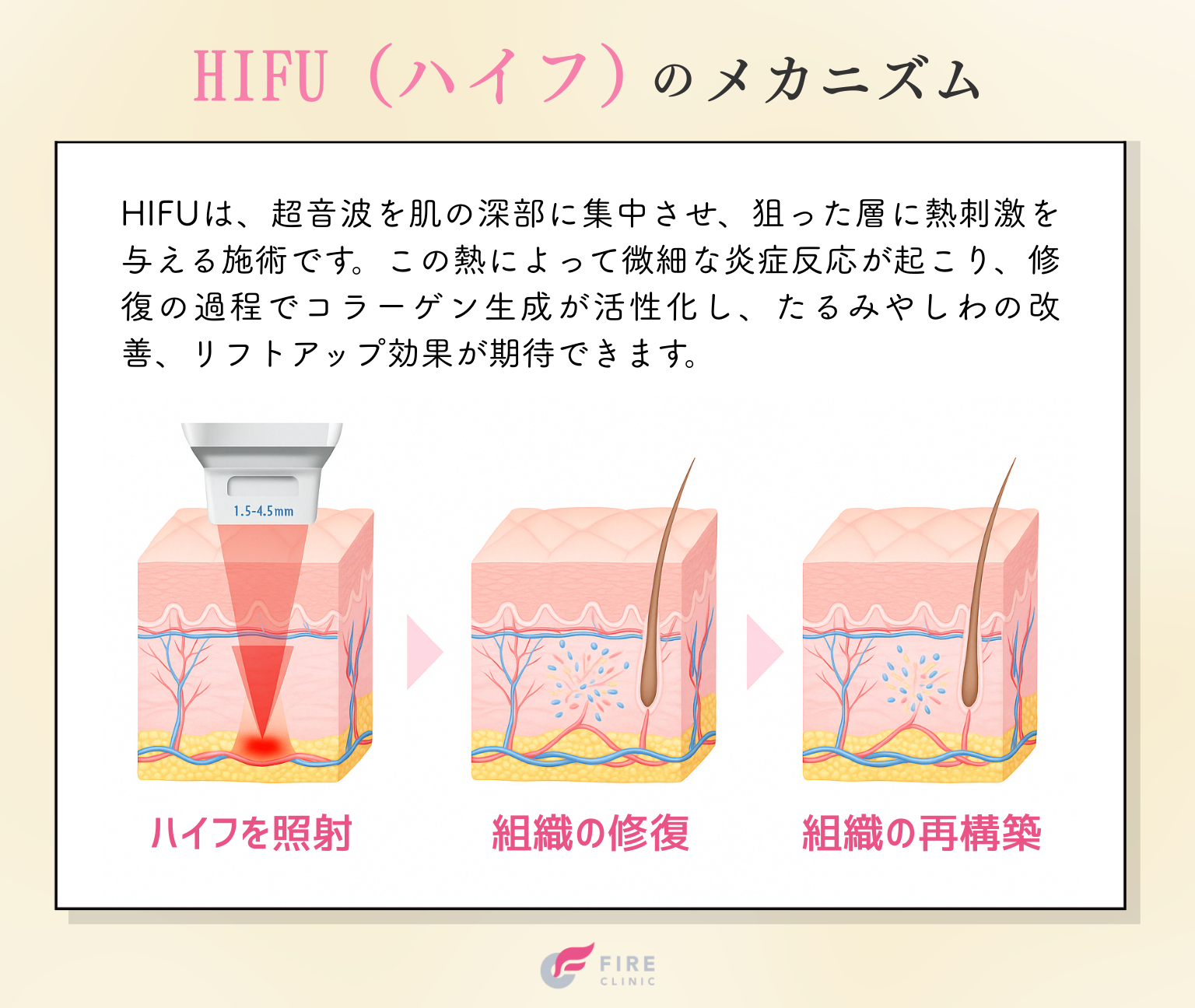 HIFU（ハイフ）治療のメカニズム