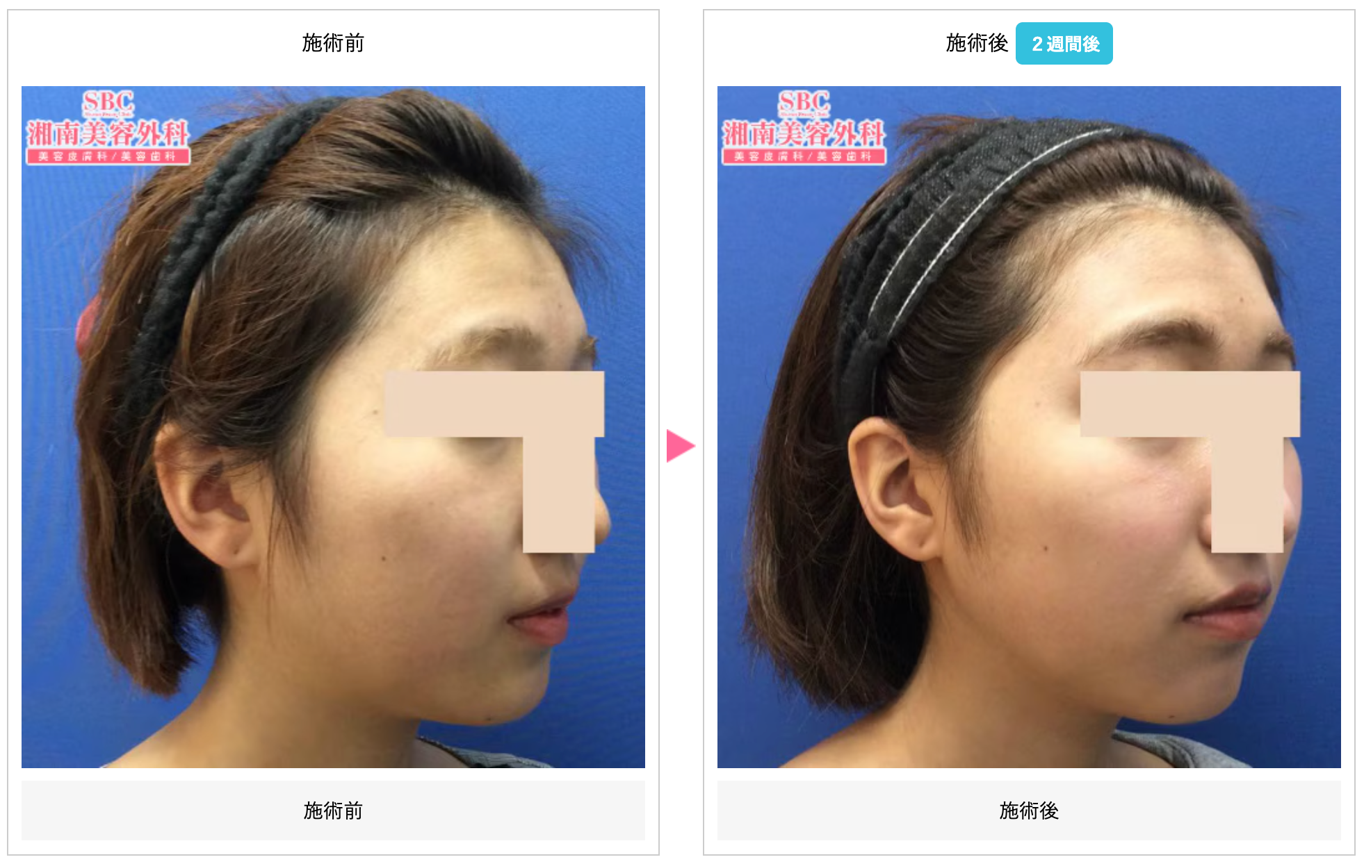 湘南美容クリニック BNLS注射でフェイスラインが出現！