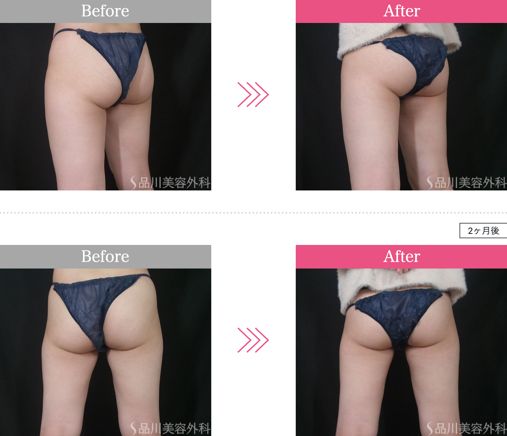 品川美容外科 脂肪冷却 バナナロール 症例