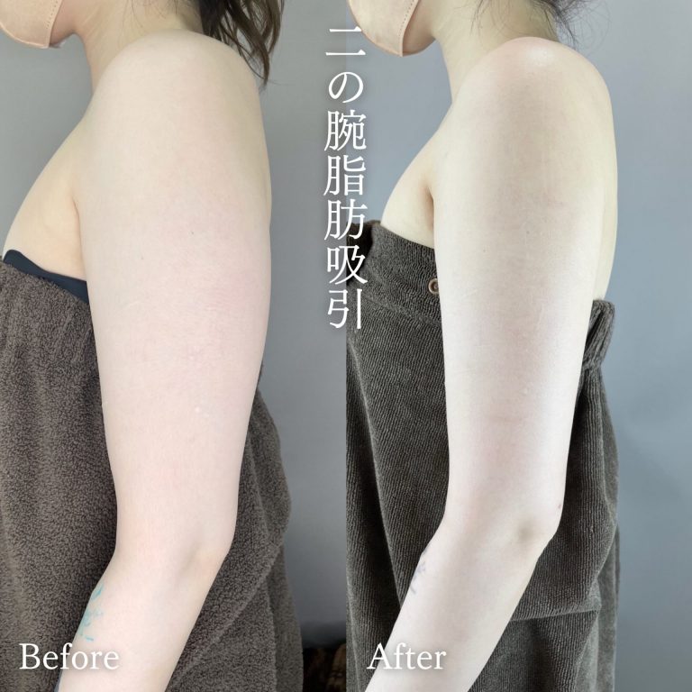 TCB 二の腕の脂肪吸引 症例写真