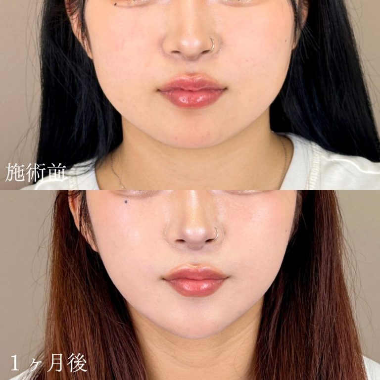 TCB 顔の脂肪吸引 症例
