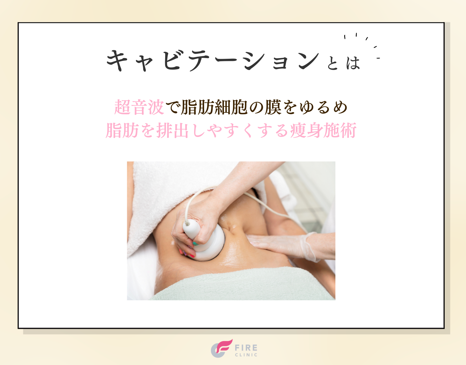 キャビテーションとは