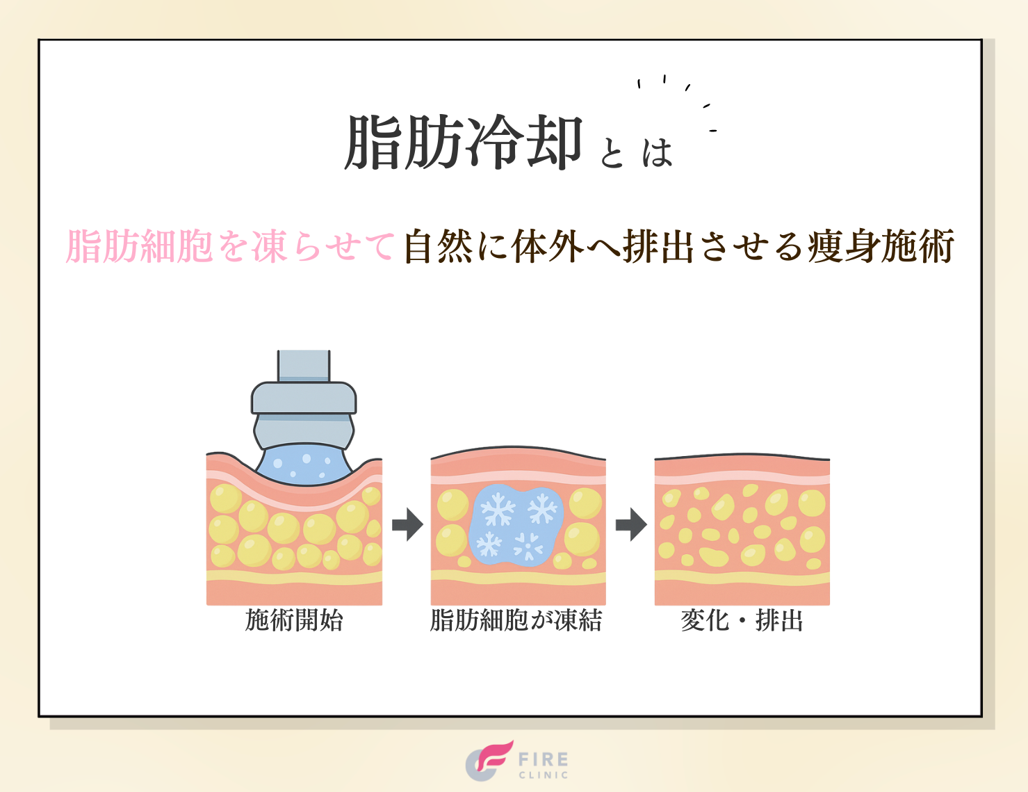 そもそも脂肪冷却とは？解説画像