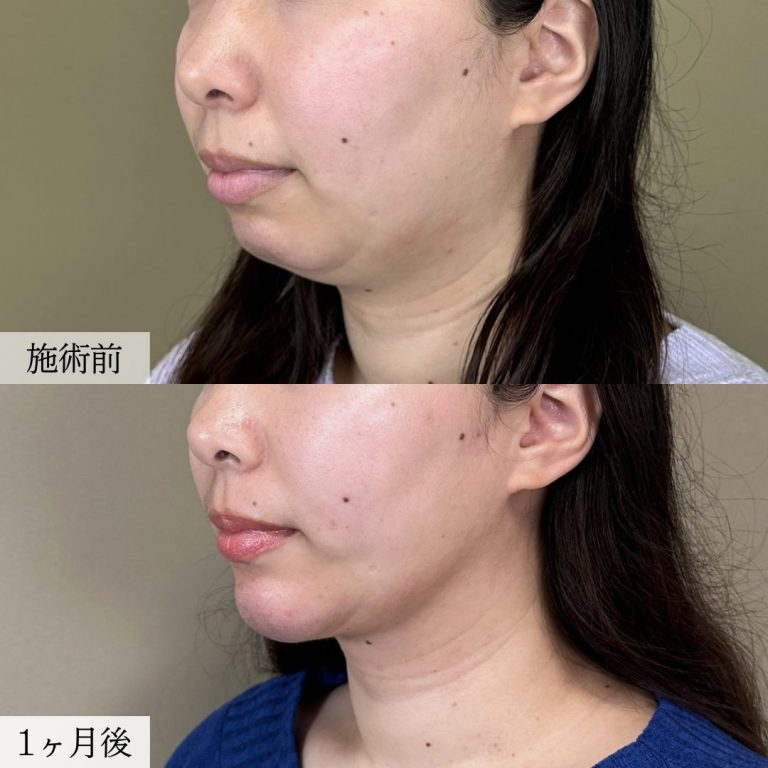 TCB 顔の脂肪吸引 症例写真