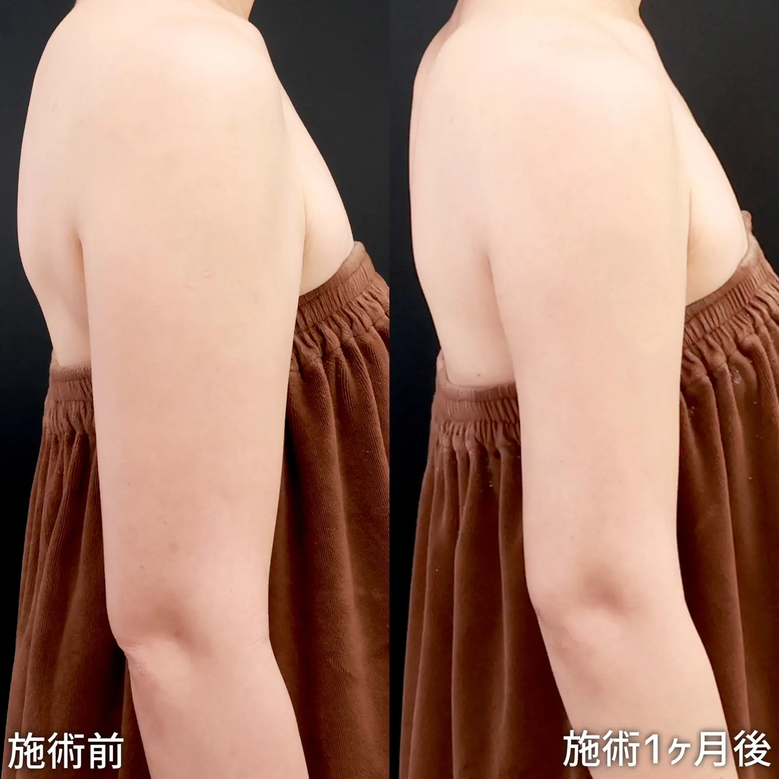 TAクリニック 二の腕の脂肪吸引 症例