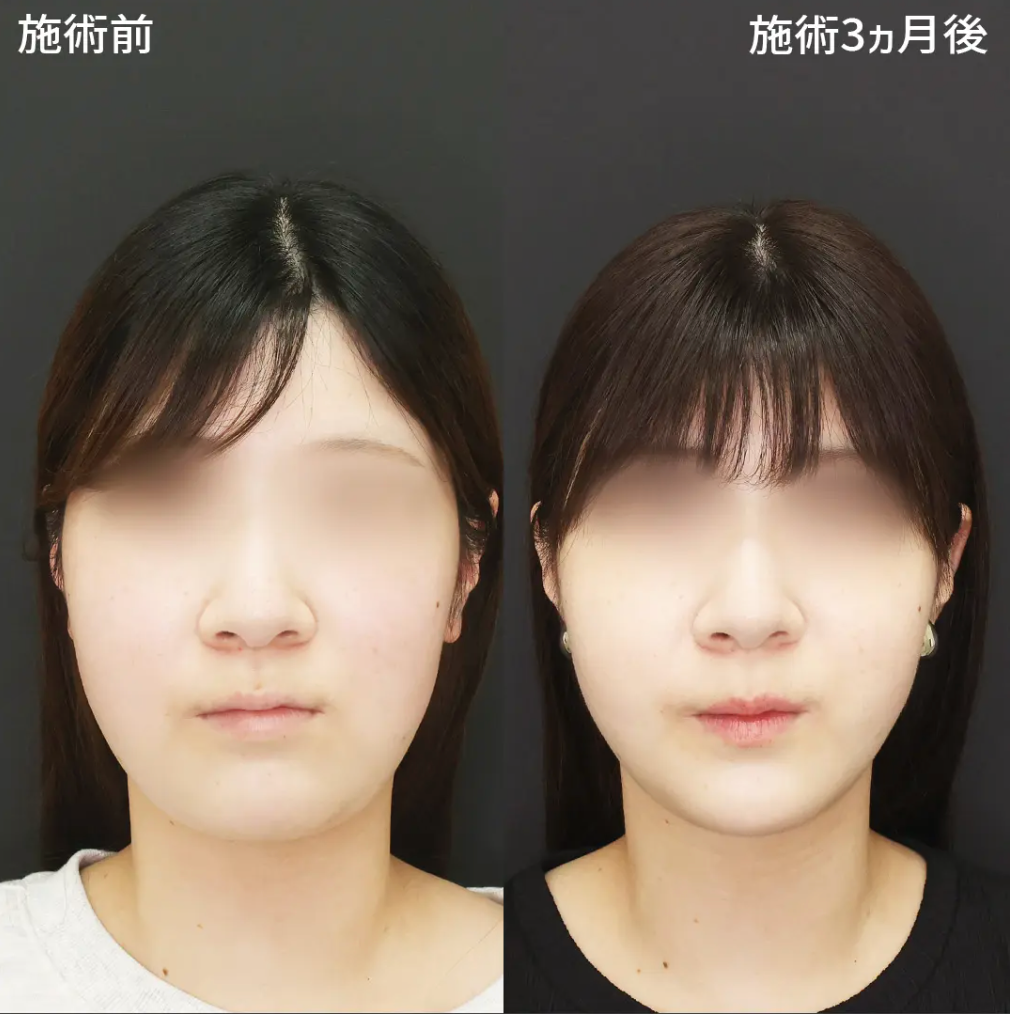 TAクリニック 顔の脂肪吸引 症例