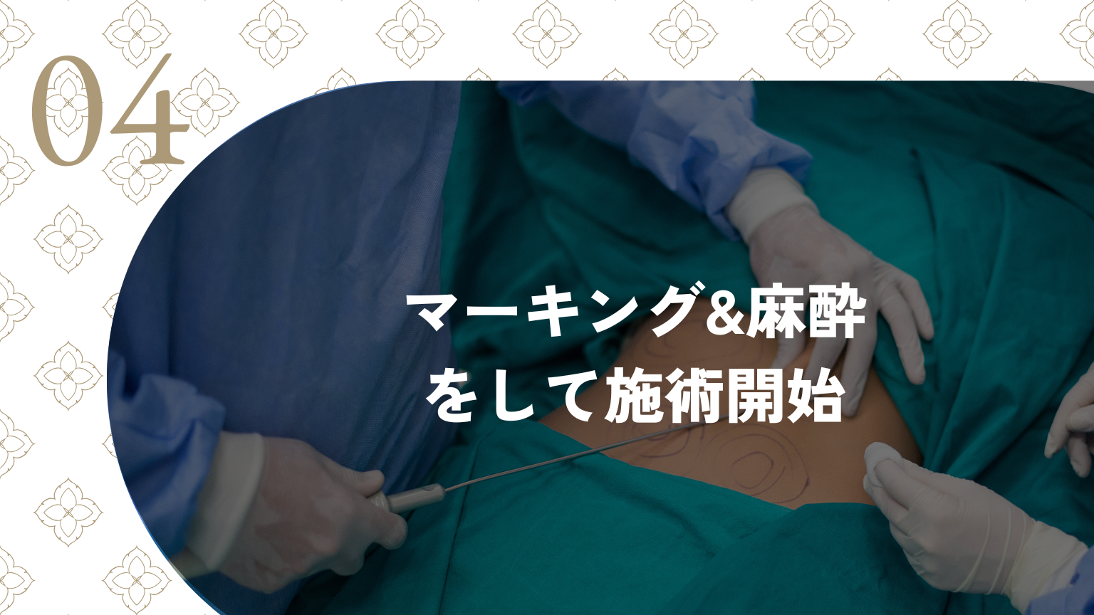 4：マーキング&麻酔をして施術開始