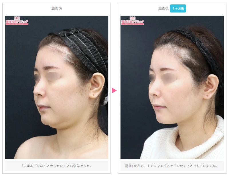湘南美容クリニックの顔の脂肪吸引症例写真