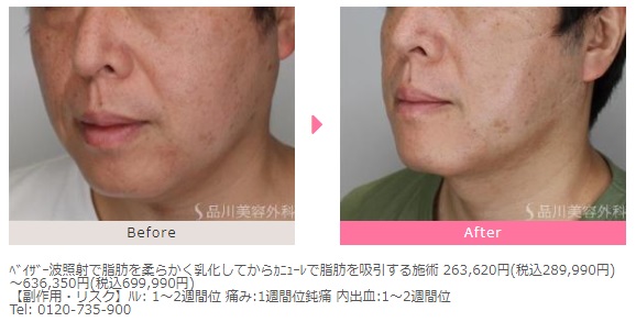品川美容外科の顔の脂肪吸引症例写真