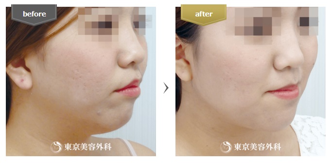東京美容外科の顔の脂肪吸引症例写真