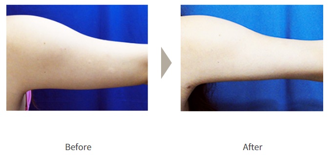 ガーデンクリニックの二の腕の脂肪吸引の症例写真