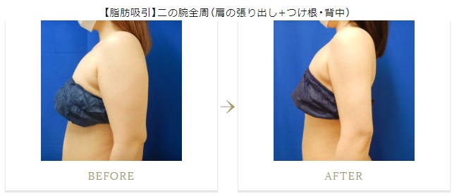 水の森美容外科の二の腕の脂肪吸引の症例写真