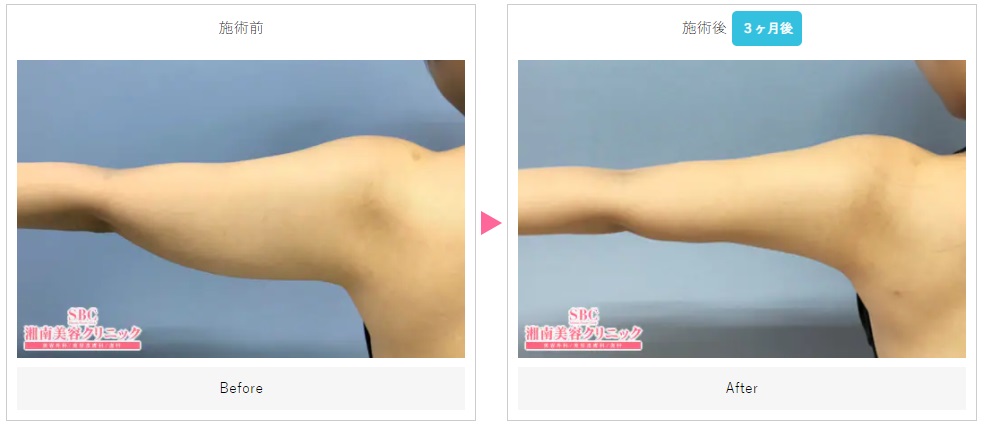 湘南美容クリニックの二の腕の脂肪吸引の症例写真