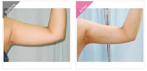 渋谷美容外科クリニックの二の腕の脂肪吸引の症例写真
