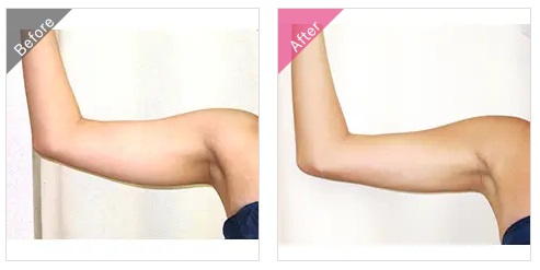 渋谷美容外科クリニックの二の腕の脂肪吸引の症例写真