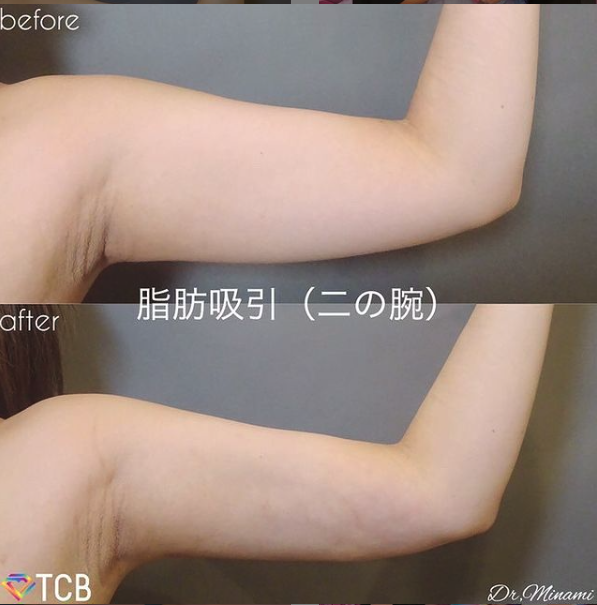 TCBの二の腕の脂肪吸引の症例写真