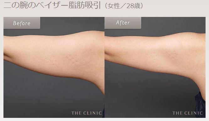 THE CLINICの二の腕の脂肪吸引の症例写真