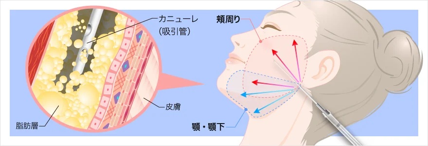 TCBの顔の脂肪吸引の方法