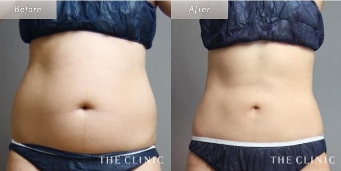 THE CLINICのお腹の脂肪吸引症例写真