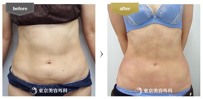 東京美容外科のお腹の脂肪吸引症例写真