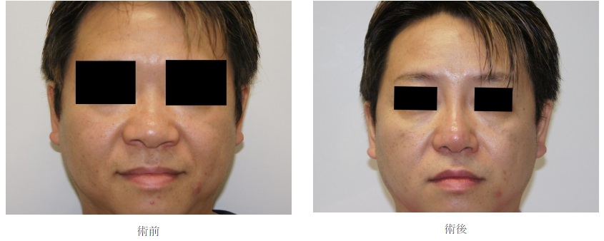 コスメディカルクリニックシンシアの鼻整形症例写真