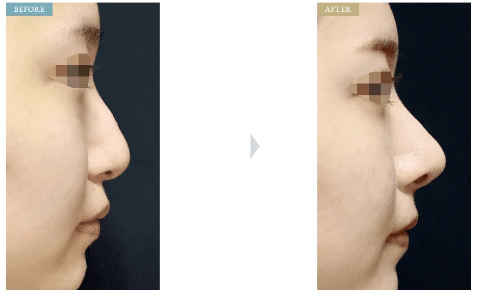 ジョウクリニックの鼻整形症例写真