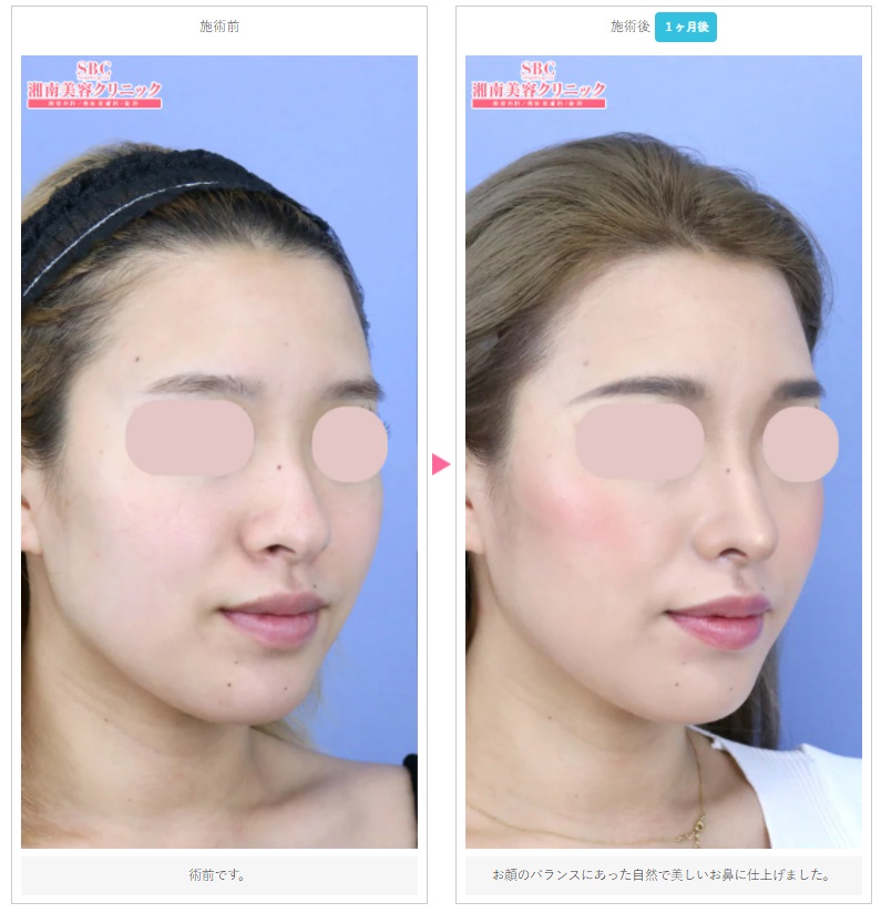 湘南美容クリニックの鼻整形症例写真