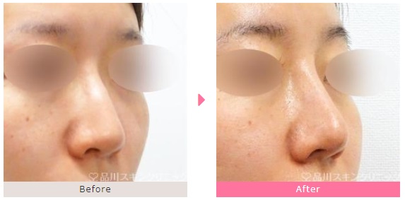品川美容外科の鼻整形症例写真
