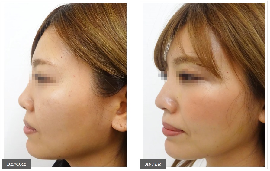 TCBの鼻整形症例写真