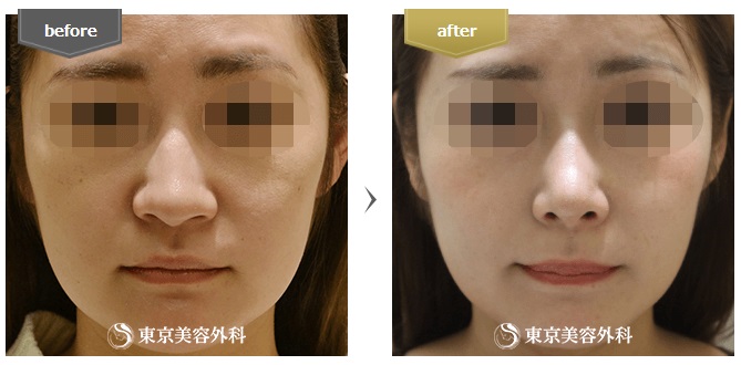 東京美容外科の鼻整形症例写真