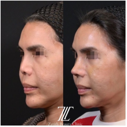ゼティスビューティークリニックの鼻整形症例写真