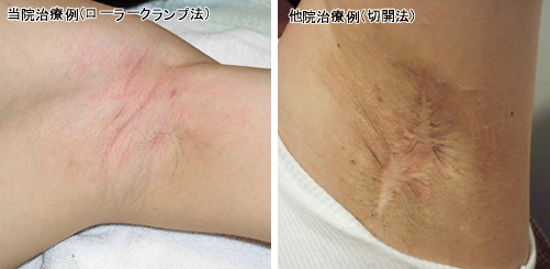 共立美容外科のワキガ治療症例写真