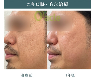 オラクル美容皮膚科のニキビ跡治療症例写真