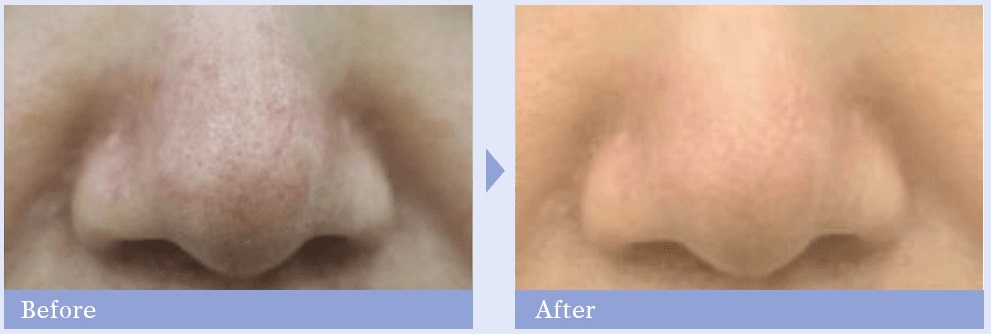 湘南美容クリニックのいちご鼻・毛穴の黒ずみ治療症例写真