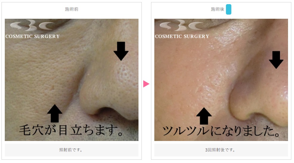 湘南美容クリニックのいちご鼻・毛穴の黒ずみ治療症例写真