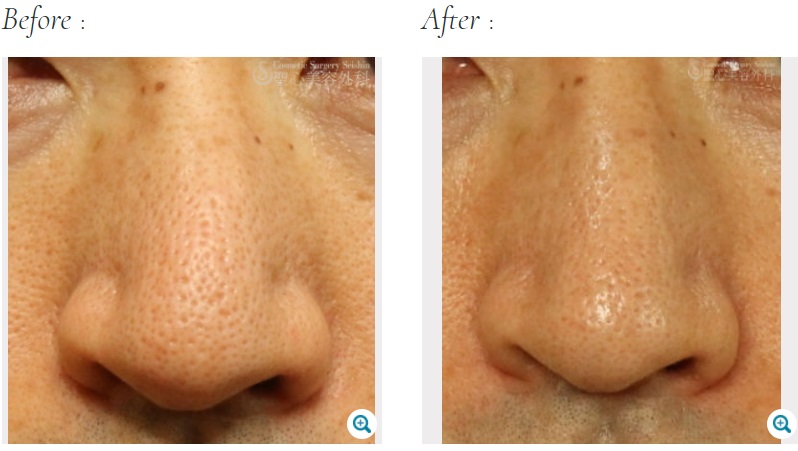 聖心美容クリニックのいちご鼻・毛穴の黒ずみ治療症例写真