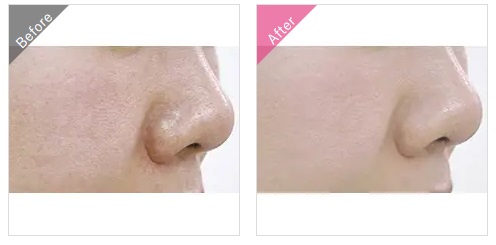 渋谷美容外科クリニックのいちご鼻・毛穴の黒ずみ治療症例写真