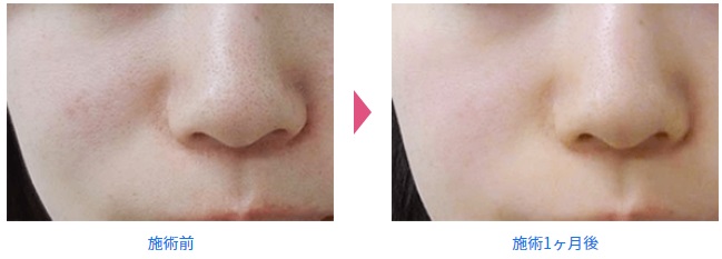 品川スキンクリニックのいちご鼻・毛穴の黒ずみ治療症例写真