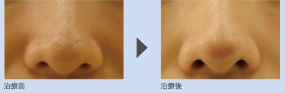 タカミクリニックのいちご鼻・毛穴の黒ずみ治療症例写真