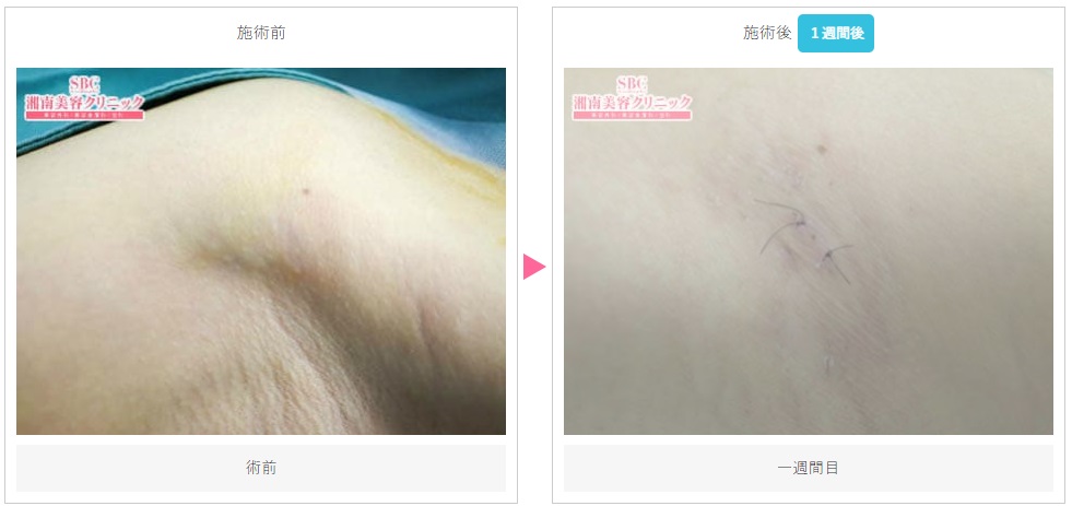 湘南美容クリニックのワキガ治療・手術症例写真