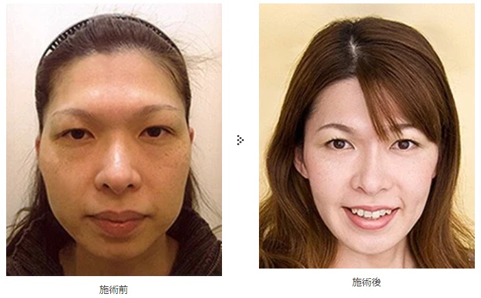 共立美容外科の小顔整形症例写真
