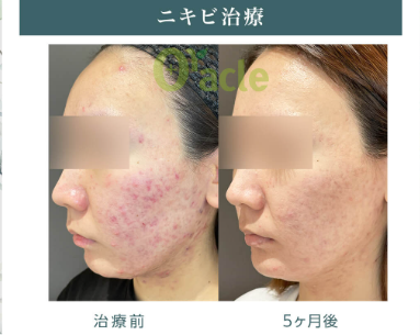 オラクル美容皮膚科のニキビ治療症例写真