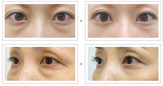 品川美容外科の「目の下のふくらみ取り」の症例写真