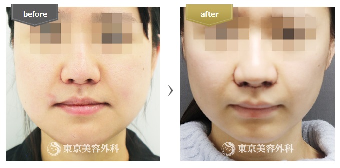 東京美容外科の小顔整形症例写真
