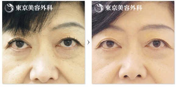 東京美容外科の「目の下のたるみ取り」症例写真