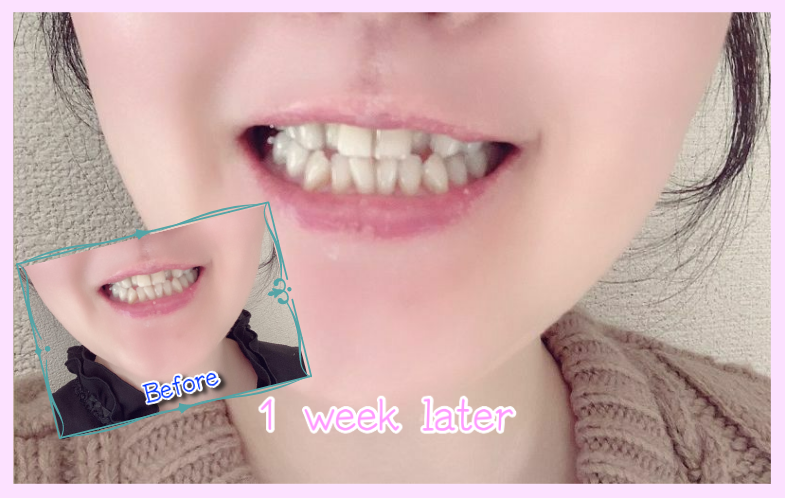 デンタルラバースーパーホワイトLV使用１週間後の歯