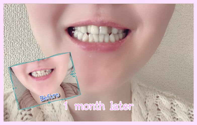 デンタルラバースーパーホワイトLV使用１ヶ月後の歯